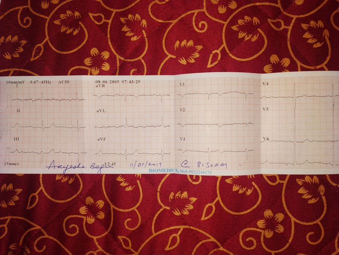 What does this ECG show?