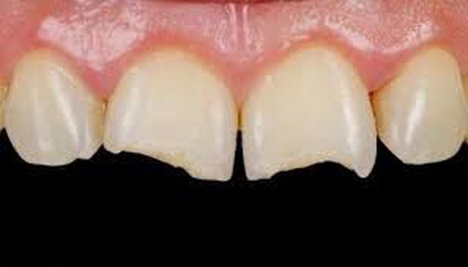 Class 4 caries
