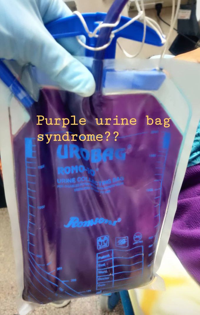 Purple Urine Bag Syndrome??