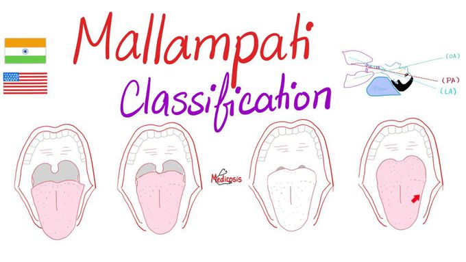 Mallampati Score (Classification) for Airway Management