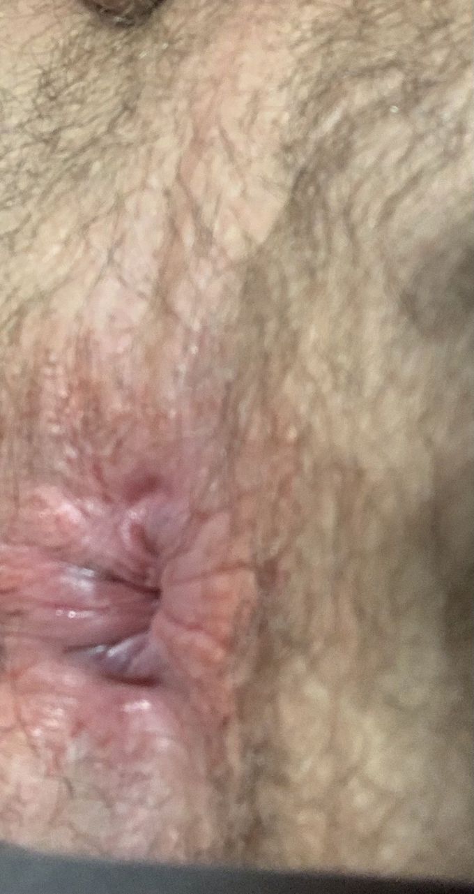 Is this Piles?