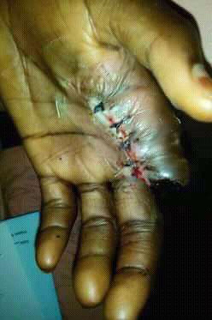 Diabetes case in hospital.