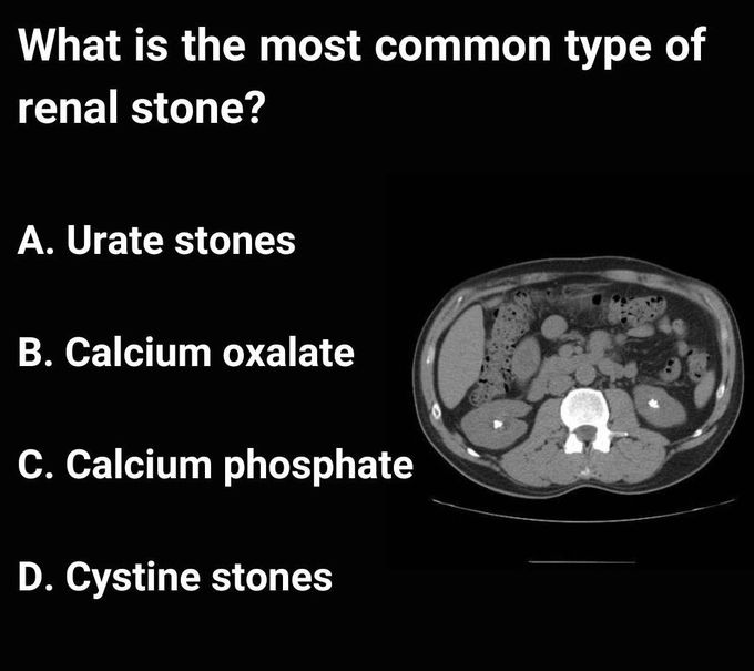Renal Stone