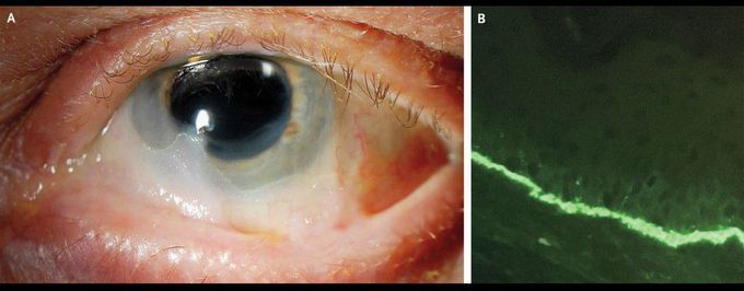 Symblepharon in Linear IgA Bullous Dermatosis