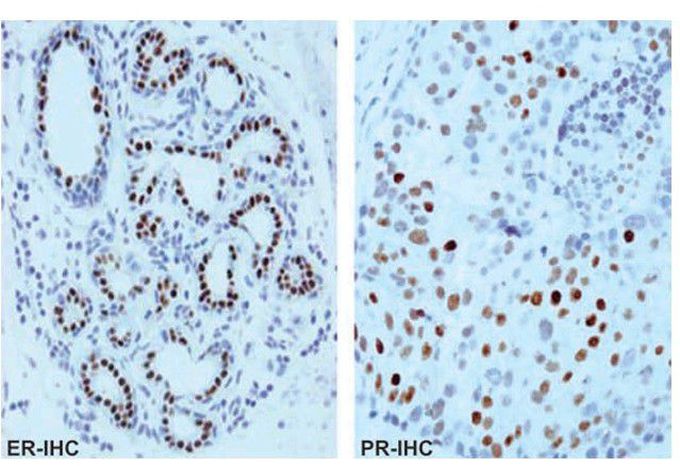 Oestrogen and progesterone hormonal receptors (ER and PR) in breast cancer.