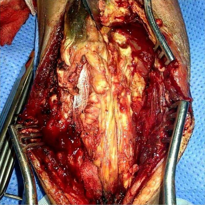 Required surgery in a young woman with compartment syndrome which later became infected with MRSA
