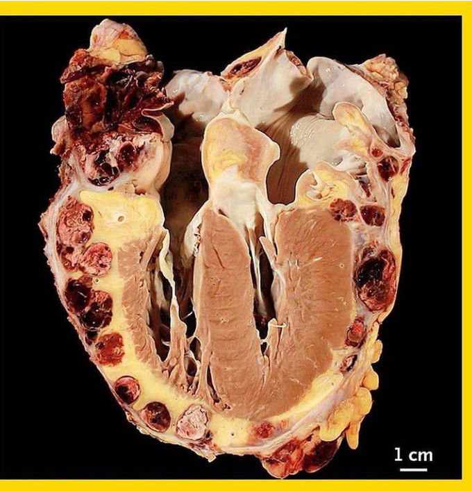 Angiosarcoma