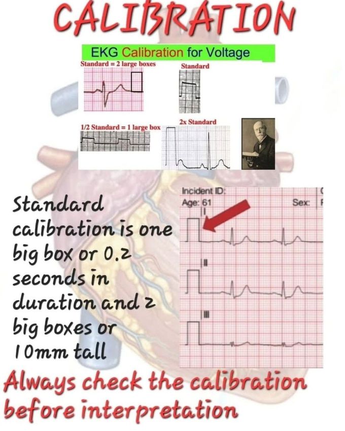 EKG Calibration