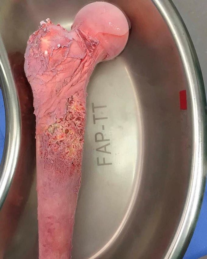 Ewing’s Sarcoma
