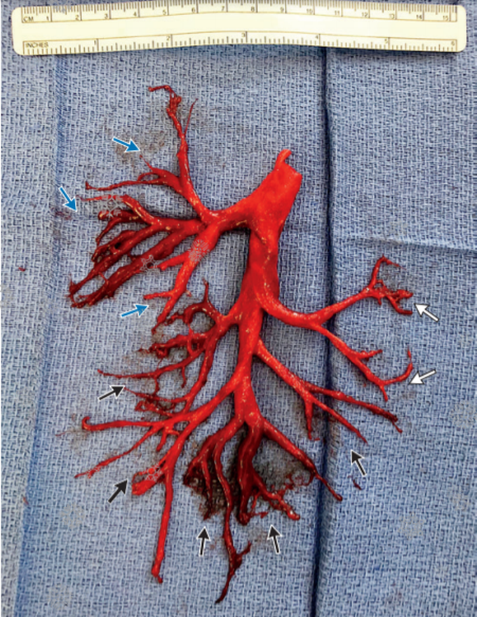 Cast of Right Bronchial Tree Expectorated by a Patient