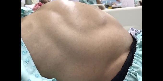 The Peristalsis in Bowel obstruction
