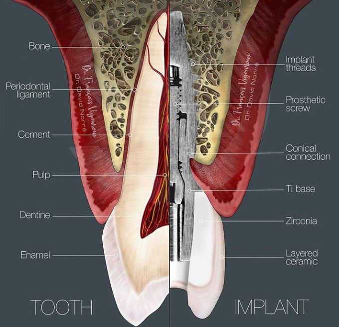 Tooth Implant