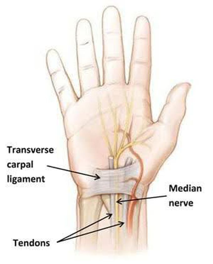Treatment of carpal tunnel syndrome