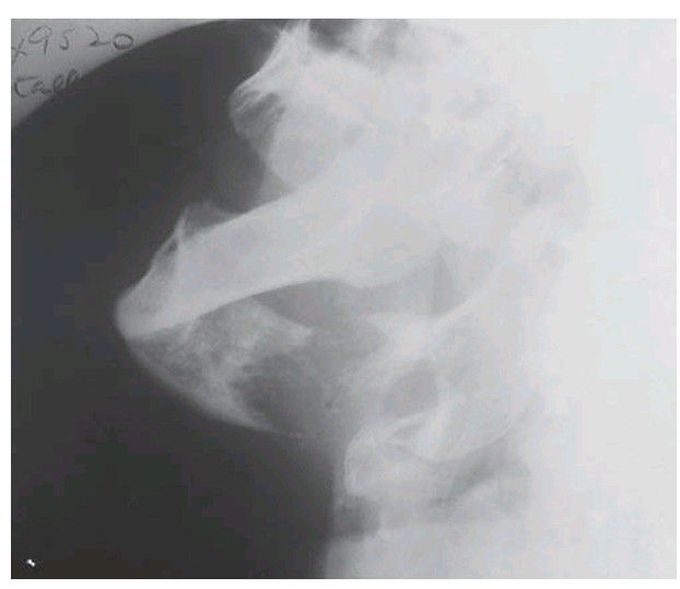 Metastatic carcinoma in the mandible