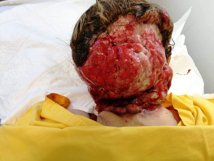 Squamous cell carcinoma of the nape