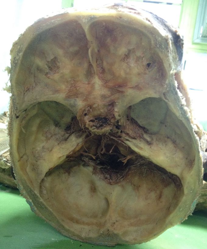 The cranium