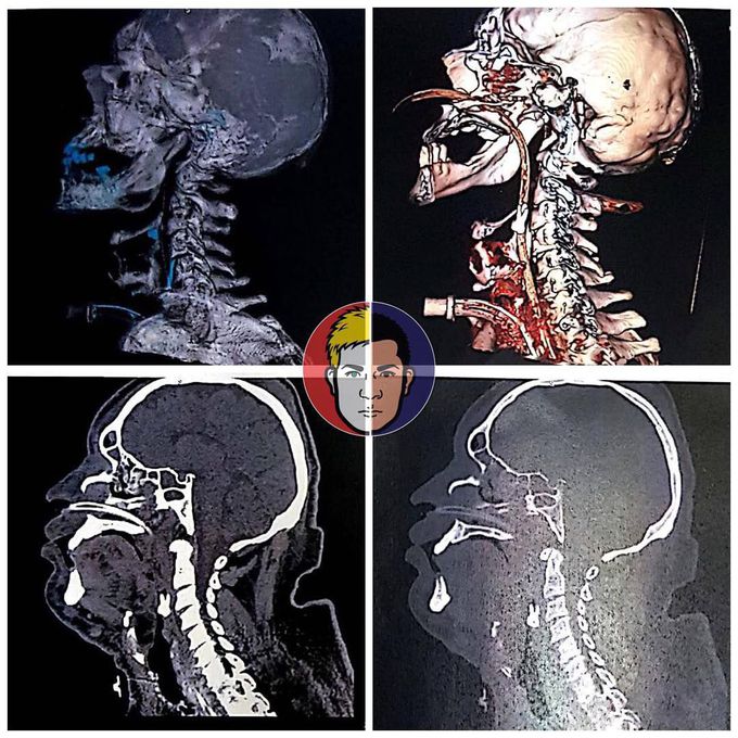 What do you see on CT scan?