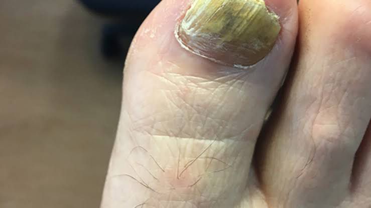 Causes of fungal nail infection - MEDizzy