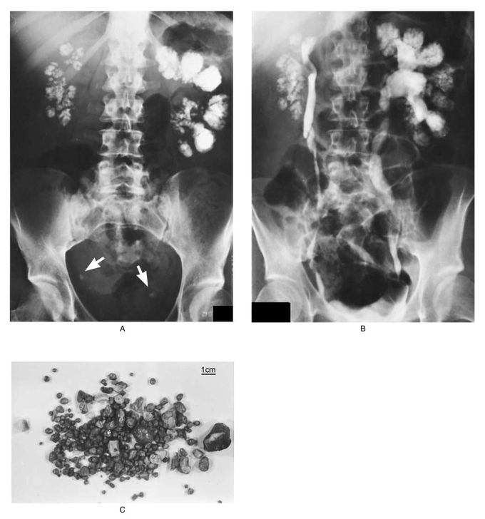 Bilateral Nephrocalcinosis