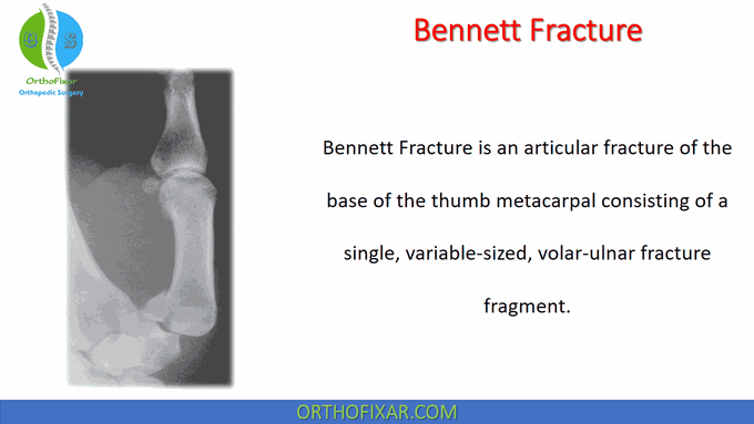 Bennett Fracture • Easy Explained - OrthoFixar 2022