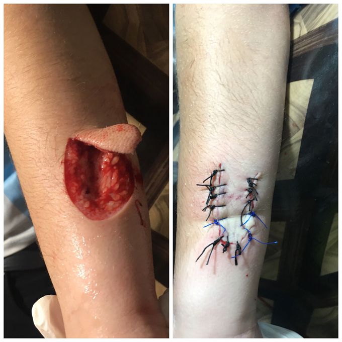 Forearm injury