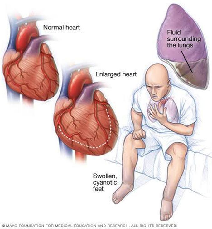 Congestive heart failure