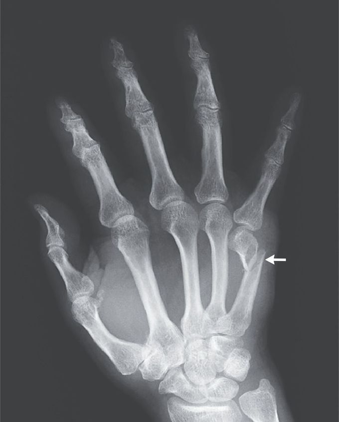 Boxer’s Fracture