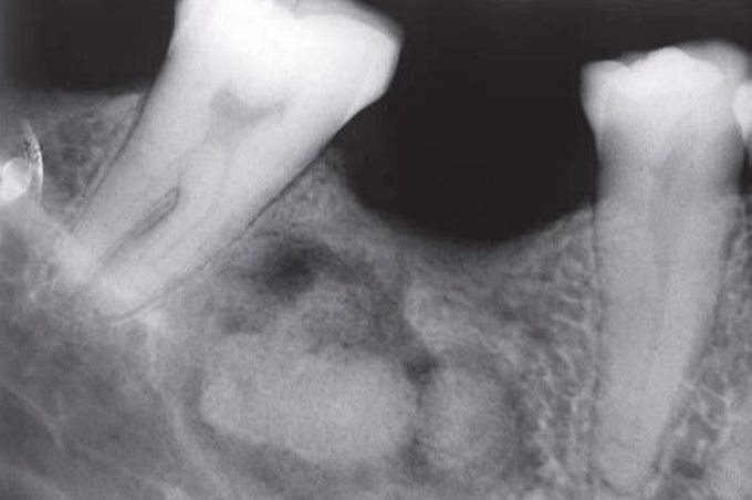 Focal sclerosing osteitis