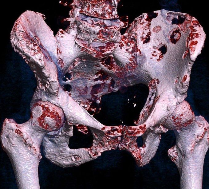Extensive bone cancer metastases!! ☠️ 