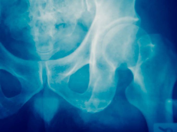 Antibody reduces bone metastases '100-fold'