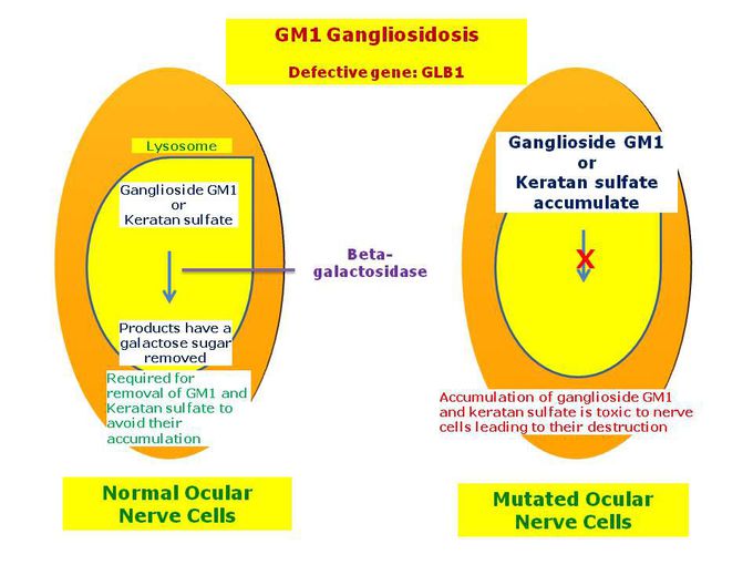 Gangliosidosis GM1