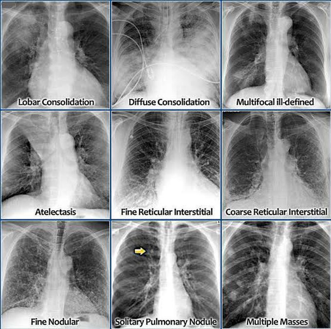 Chest x-rays 🩻