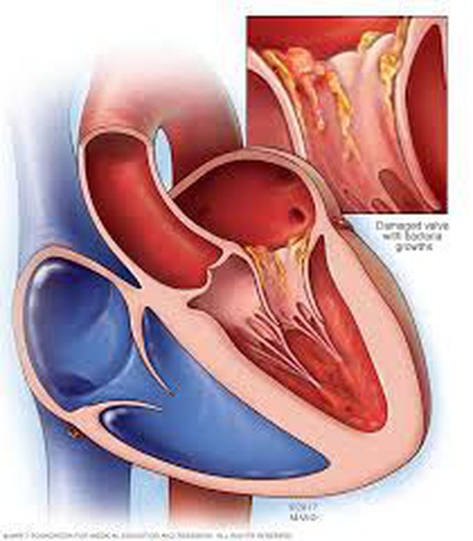 Causes of endocarditis