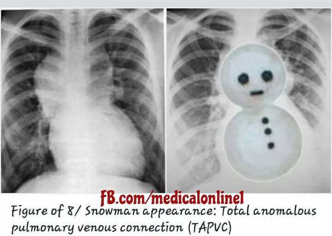 Congenital heart disease