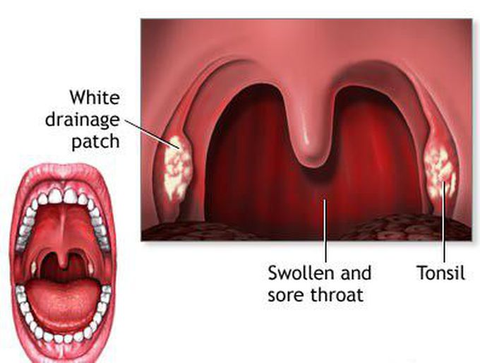 Strep throat