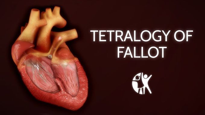 Tetralogy of Fallot