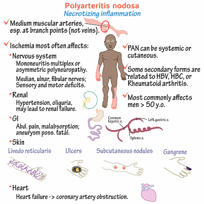 Polyarteritis Nodosa