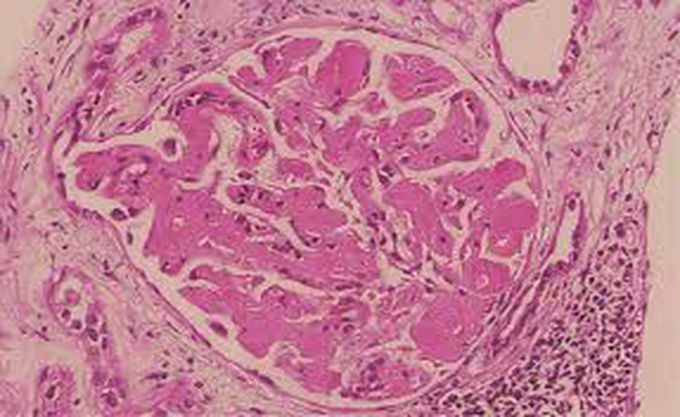 Renal amyloidosis