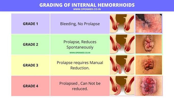 Grading Of internal Hemorrhoids