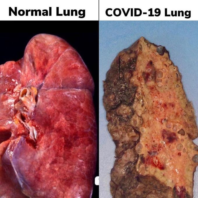Normal lung / covid lung