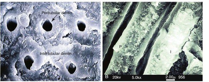 Fracture of dentin