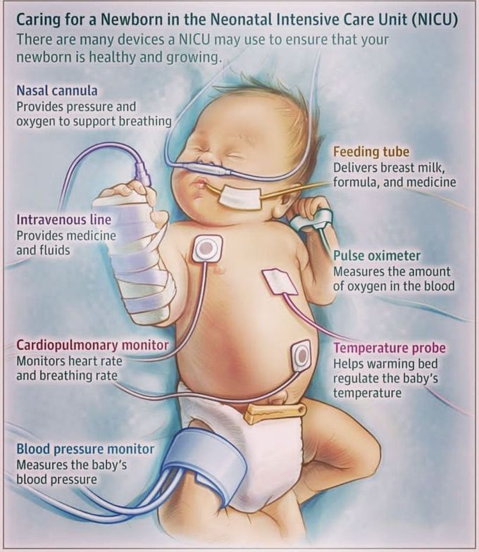 Neonatal intensive care unit  nicu.