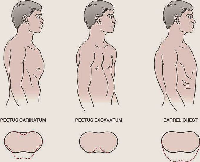 Abnormal Chest Shape