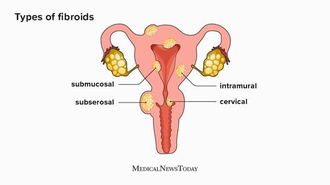 Types of fibroids - MEDizzy