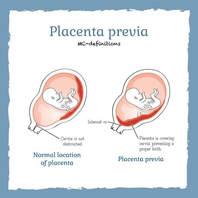 Placenta Previa