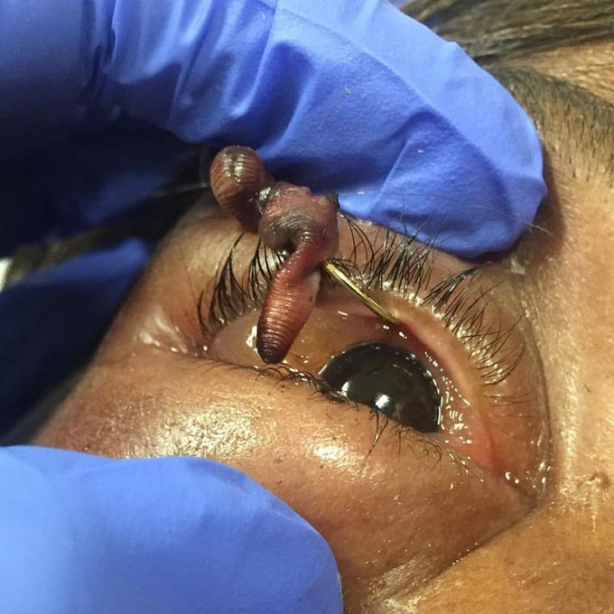 Case of a patient with a fish hook lodged in the eyelid with the bait (worm) still attached.
