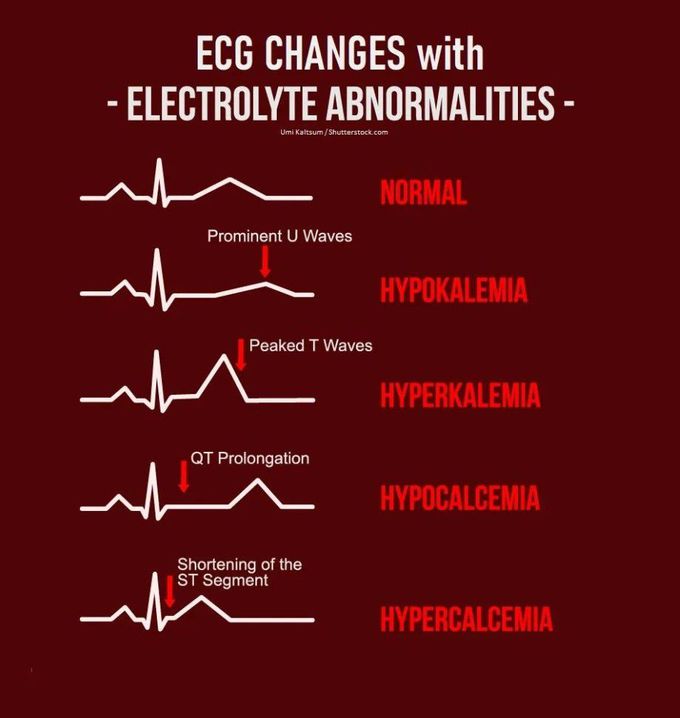 ECG Changes with Electrolyte Abnormalities