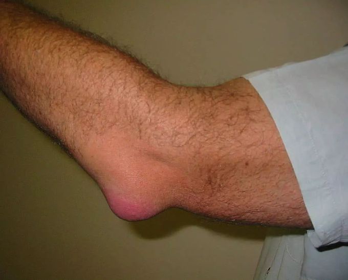 Olecranon Bursitis