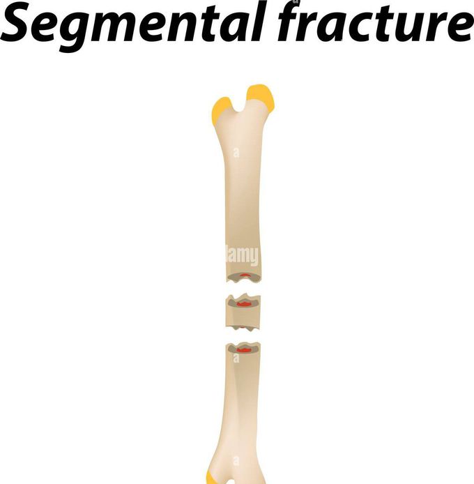 Segmental Fracture