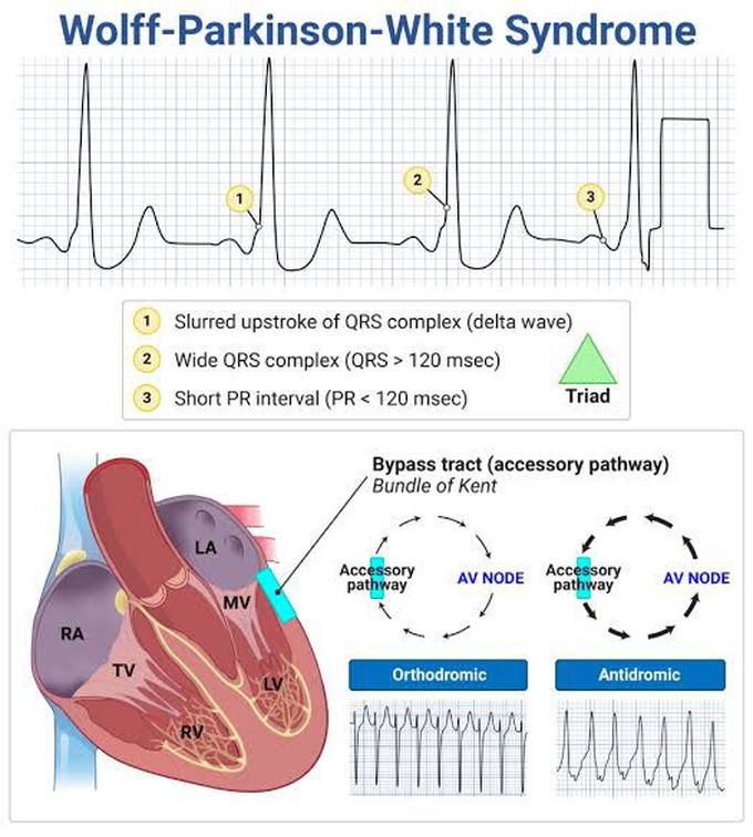 Wolff-Parkinson-White Syndrome
